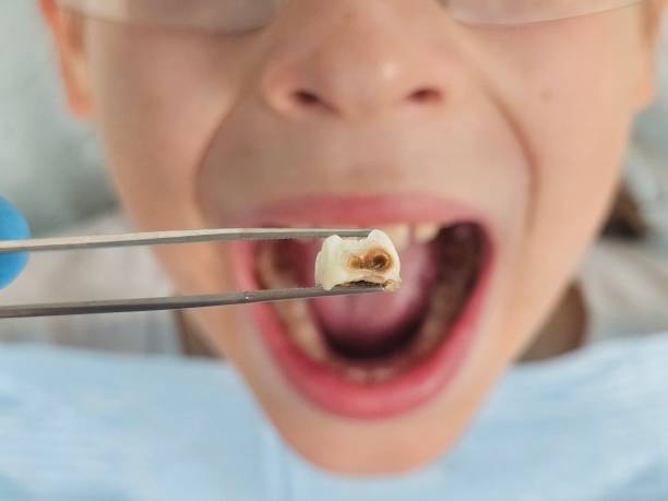 Best Emergency Dental Care for Broken or Chipped Teeth in Neah Bay, WA